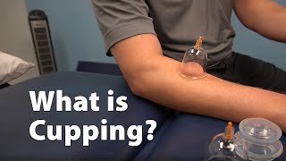 What is Cupping [upl. by Ajiak]