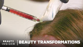 How To Restore Hair Growth With PlateletRich Fibrin  Beauty Transformations [upl. by Ittap]