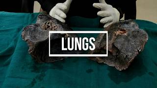 Lungs  gross anatomy [upl. by Zink851]